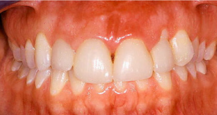 Crown lengthening before treatment
